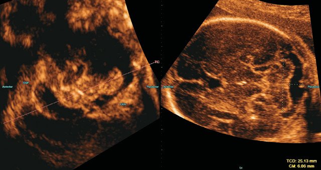 УЗИ головного мозга плода - трансцеребеллярная плоскость