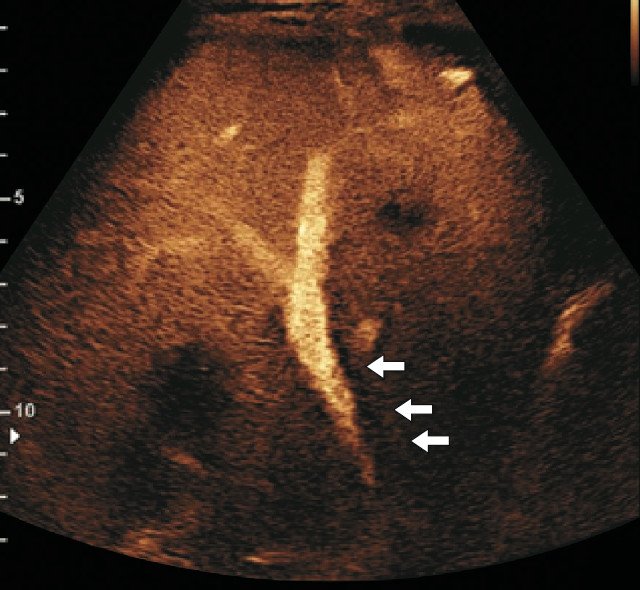 УЗИ печени с введением контрастного препарата в виде микропузырьков - усиления сигнала вдоль линии ожидаемого хода печеночной артерии (стрелки) не выявлено