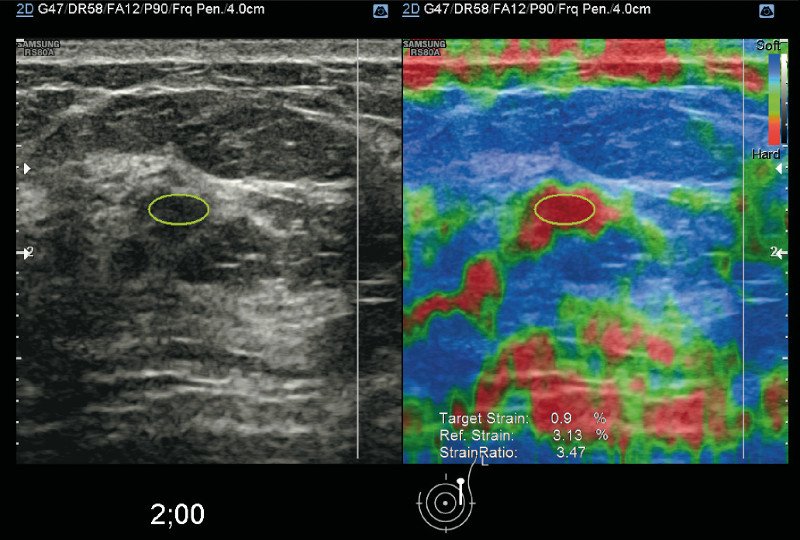 Ультразвуковая эластография молочных желез с технологией E-Breast - расчет среднего отношения деформации
