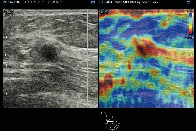 Ультразвуковая эластография образования молочной железы с технологией E-Breast - по цветовой шкале Цукубы получено 5 баллов