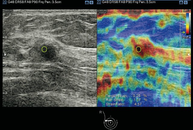 Ультразвуковая эластография образования молочной железы - отношение деформаций составило 4,57