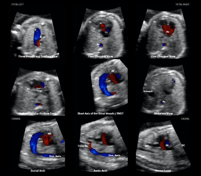 5D Heart Color - девять плоскостей сердца плода (26 недель) с признаками аномальной анатомии и гемодинамики