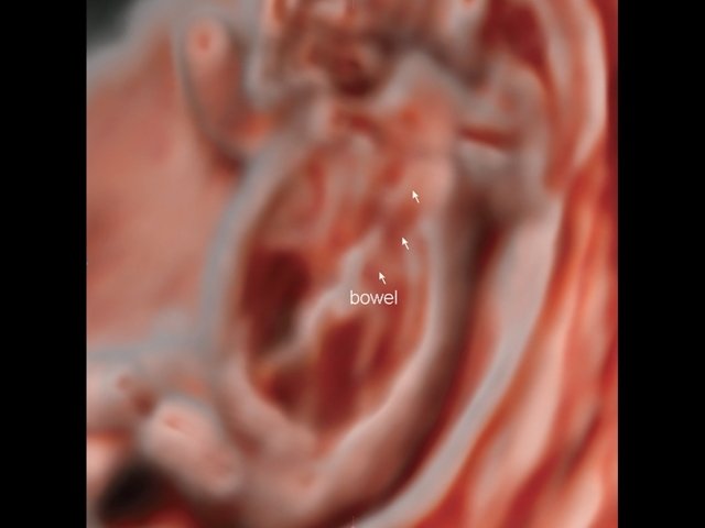 Диафрагмальная грыжа с выходом кишечника, 13 нед беременности