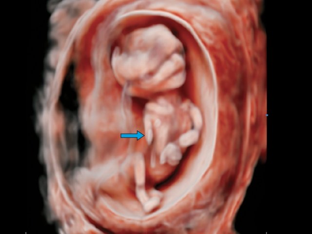 Редукционный порок развития руки, 13 нед беременности