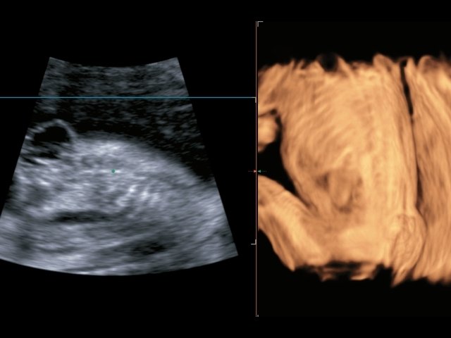 Spina-bifida, режим поверхностной реконструкции