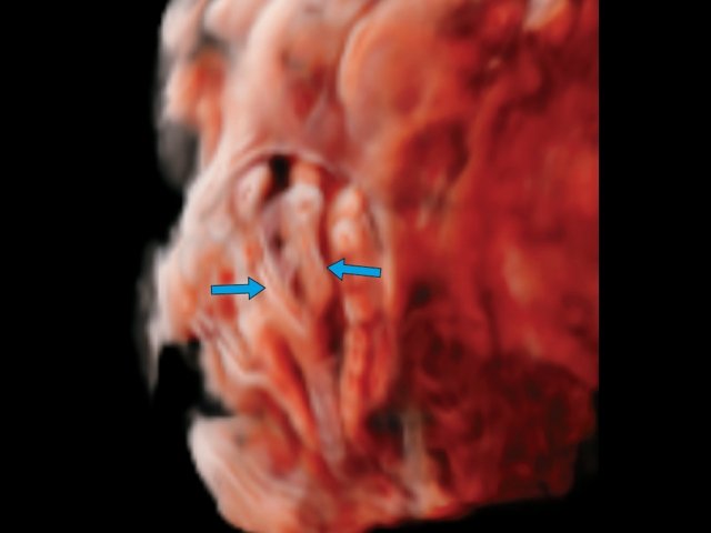 Выраженный сколиоз и дипломиелия спинного мозга