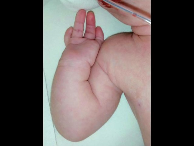 Кисть новорожденного при синдроме Нагера