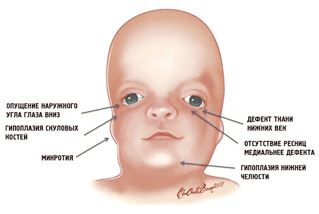 Схема специфических признаков лицевых дизморфий при синдроме Тричера Коллинза