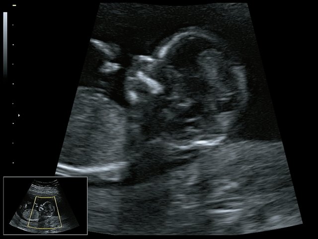 Микрогнатия - сагиттальный скан в 2D, беременность 13 нед
