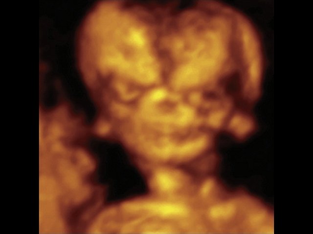 Треугольная форма лица плода при синдроме Тричера Коллинза, аномальная форма и положение ушей в 3D (беременность 13 нед)