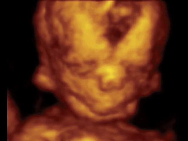 Фенотип лица плода с синдромом Тричера Коллинза, беременность 13 нед