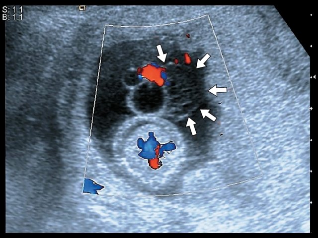 Гетерогенное образование, связанное с пуповиной (стрелки), асцит - поперечное трансабдоминальное сканирование, режим ЦДК