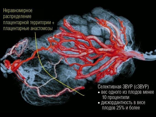 Распределение сосудов в плаценте монохориальной двойни при селективной ЗВУР