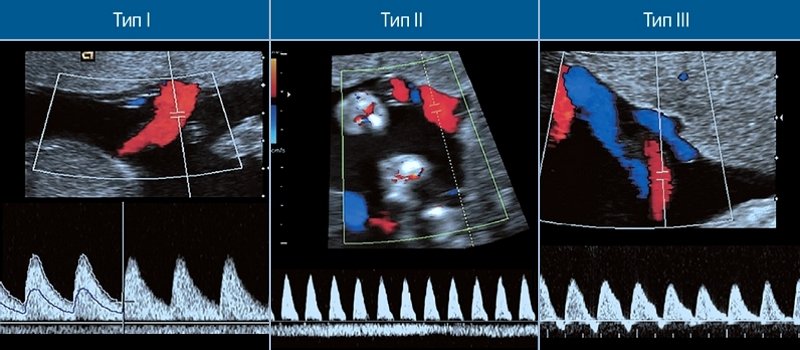 Кривые скоростей кровотока в артериях пуповины при I, II и III типах селективной ЗВУР монохориальной диамниотической двойни