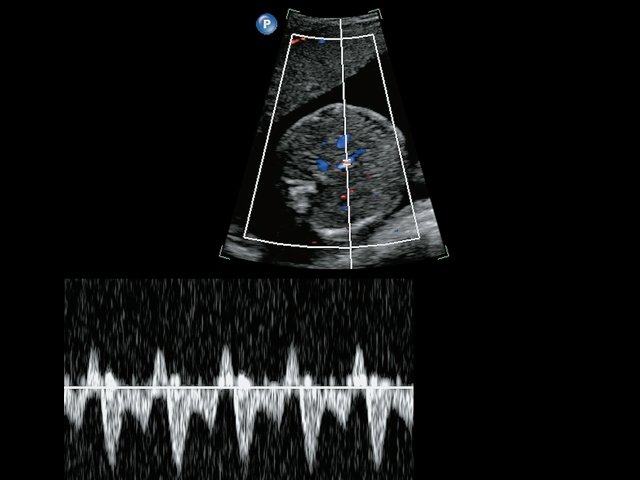 Эхограмма реверсного кровотока в венозном протоке у плода с полицитемией