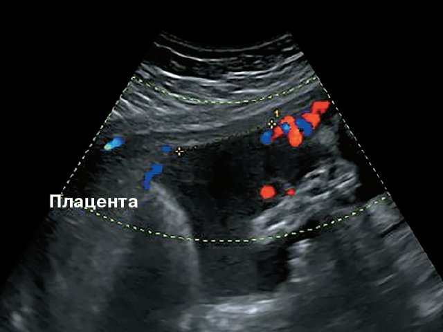 Наблюдение №1 - картина фиксированного пристеночного типа ОПП, беременность 21–26 нед
