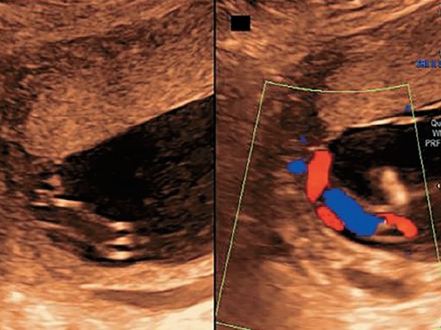 Наблюдение №3 - картина фиксированного пристеночного типа ОПП, беременность 21–26 нед