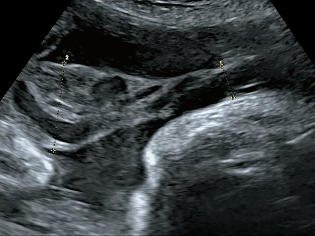 Наблюдение №5 -  виден сегмент нормальной картины ствола пуповины (1) и расширенный уплощенный сегмент (2) ближе к плаценте, беременность 33,5 нед