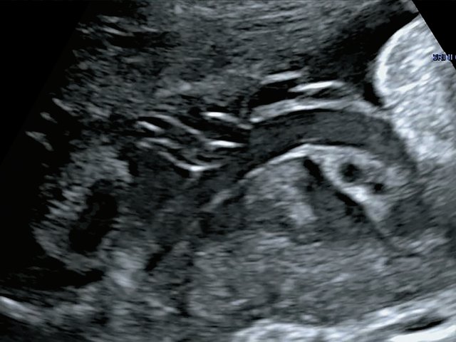 Наблюдение №5 - виден расщепленный ход сосудов пуповиныпри свободном типе ОПП в серошкальном изображении, беременность 33,5 нед
