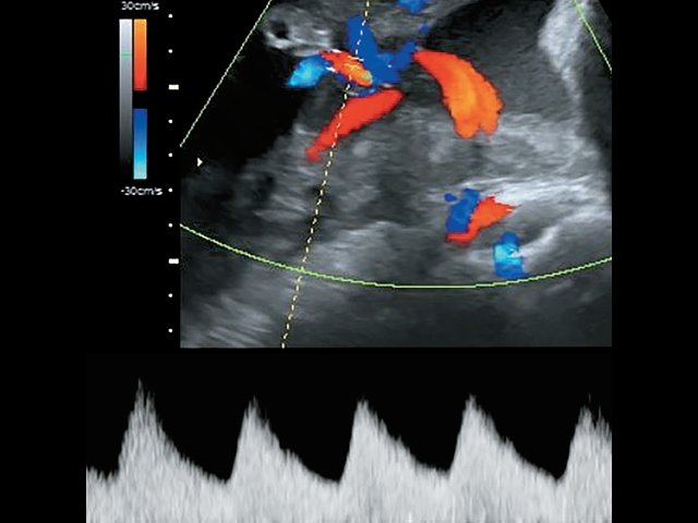 Наблюдение №5 - виден расщепленный ход сосудов пуповины с применением цветового и импульсного допплеровского картирования