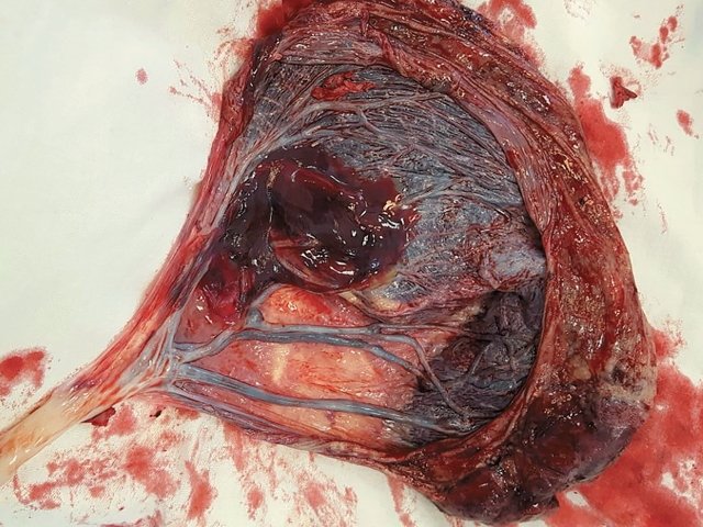 Наблюдение №5 - картина плаценты после кесарева сечения, виден расщепленный свободный ход сосудов пуповины к поверхности двух плацентарных долей