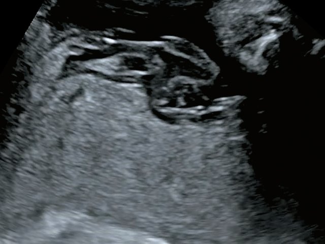 Наблюдение №7 - виден расщепленный ход сосудов пуповины над поверхностью плаценты, беременность 34,4 нед