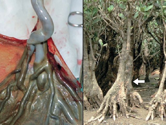 «Mangrove sign»: картина этого признака после родов и особенность роста мангрового дерева – надземное расположение корневых отростков