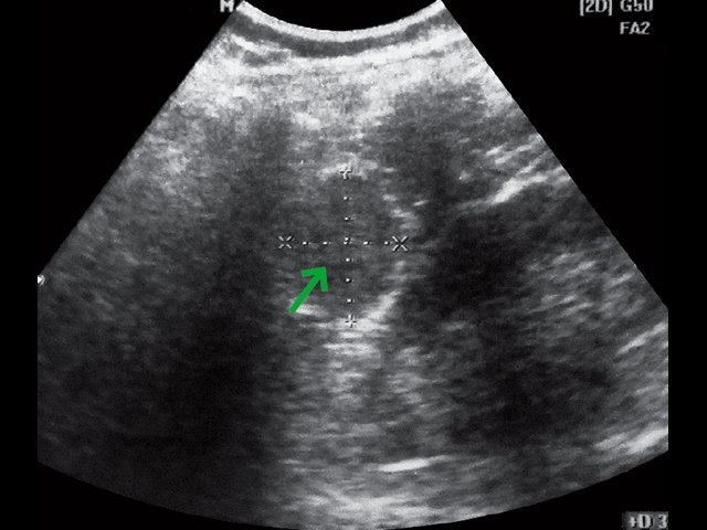 Эхограмма - в проекции ложа удаленной селезенки определяется округлое изоэхогенное внеорганное образование 4 см в диаметре