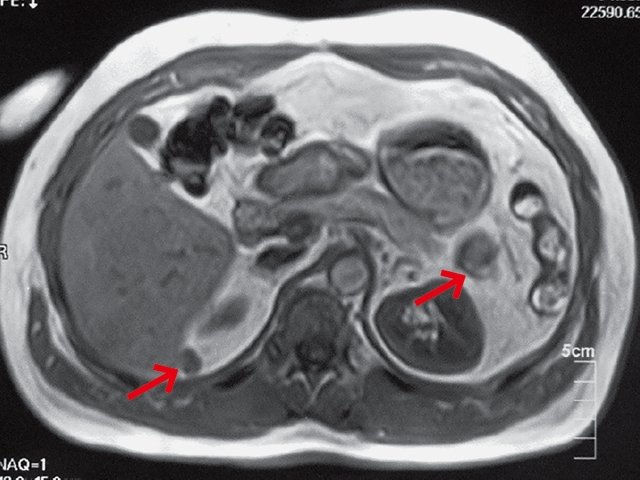 МРТ - образование, расположенное по заднему краю печени, локализовано мезоперитонеально; образование, расположенное слева, локализовано ретроперитонеально, кнаружи и спереди от почки, тесно прилежит к хвосту поджелудочной железы, диафрагме без признаков прорастания