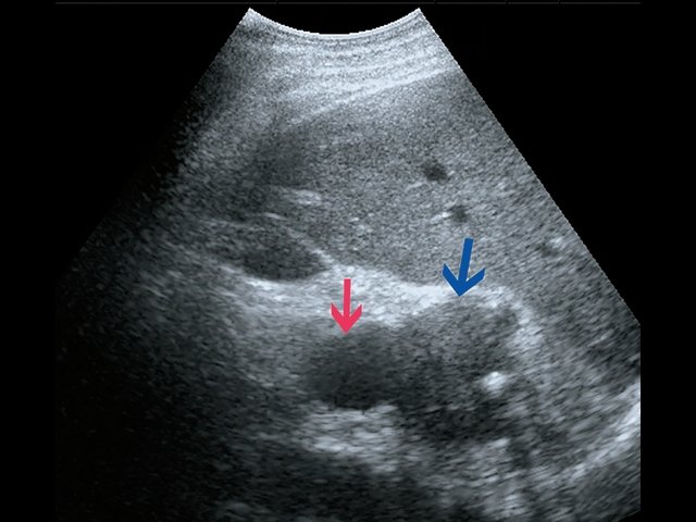 УЗ-картина фибролипосаркомы (В-режим) - визуализируется образование забрюшинно справа, внеорганное, мягкотканное, размером 4,5 см, с кальцинатом (синяя стрелка), оттесняет нижнюю полую вену (красная стрелка)