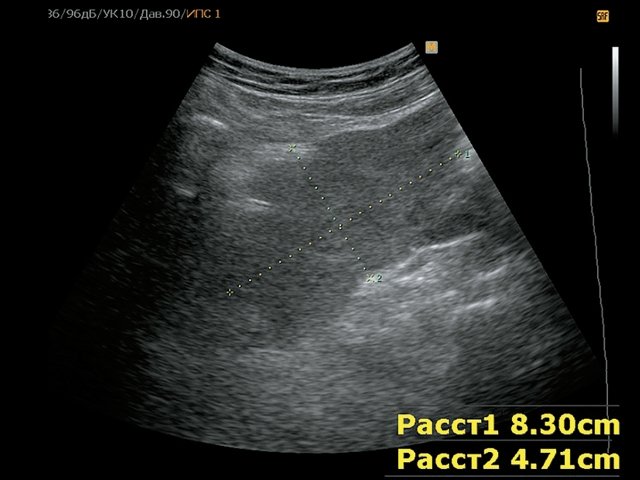 УЗ-картина внеорганного образования малого таза (B-режим) - забрюшинно справа определяется внеорганное гипоэхогенное мягкотканное образование неправильной формы, неоднородной эхоструктуры, размером до 8 см
