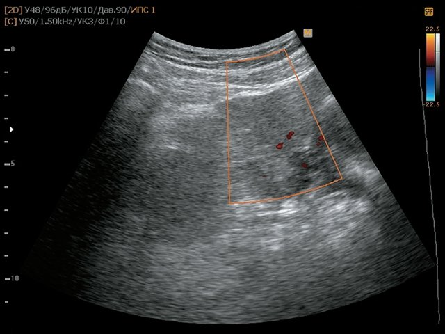 УЗ-картина внеорганного образования малого таза (режим ЦДК) - образование кровоснабжается
