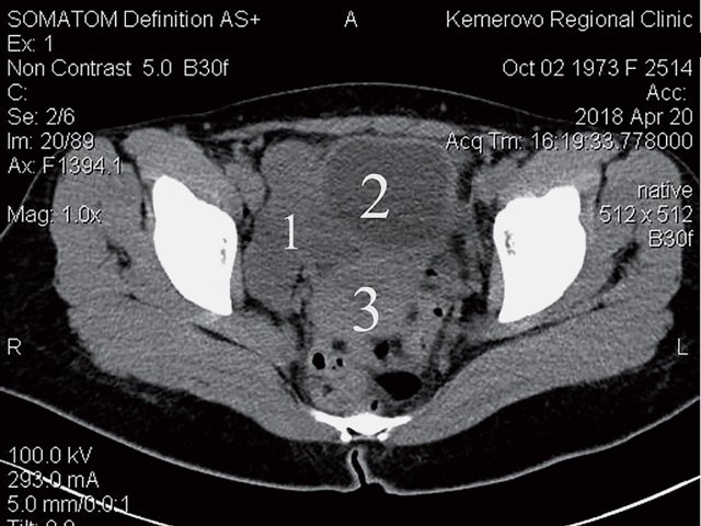 КТ (нативная фаза) - в области придатков матки справа определяется объемное образование (1), принадлежности к матке (3) и мочевому пузырю (2) не выявлено