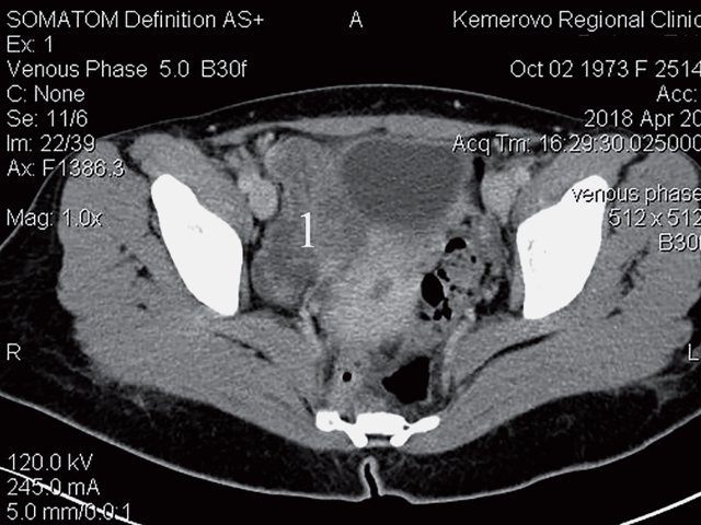 КТ объемного образования малого таза (венозная фаза) 