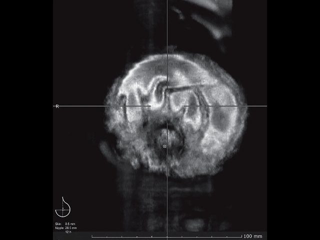 УЗ-картина разрыва импланта молочной железы - передняя проекция, коронарный срез