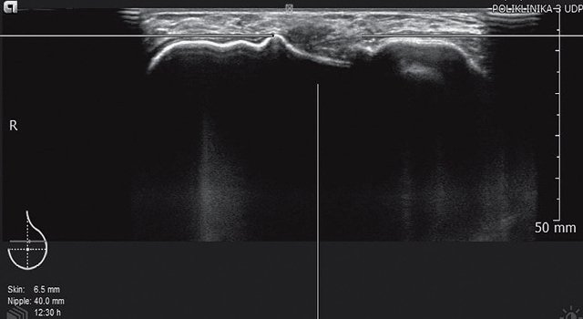 УЗ-картина разрыва импланта молочной железы - передняя проекция, горизонтальный срез