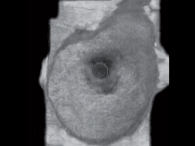 УЗ-картина правой молочной железы - передняя проекция, коронарный срез на глубине 0 мм