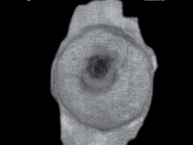 УЗ-картина левой молочной железы - передняя проекция, коронарный срез на глубине 0 мм