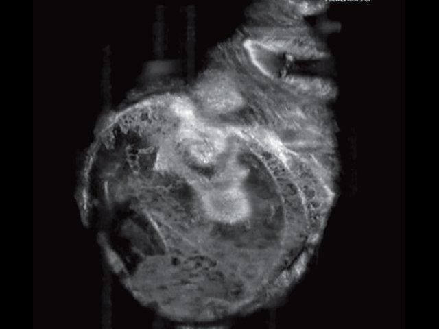 УЗ-картина правой молочной железы с эндопротезом - передняя проекция, коронарный срез на глубине 14 мм
