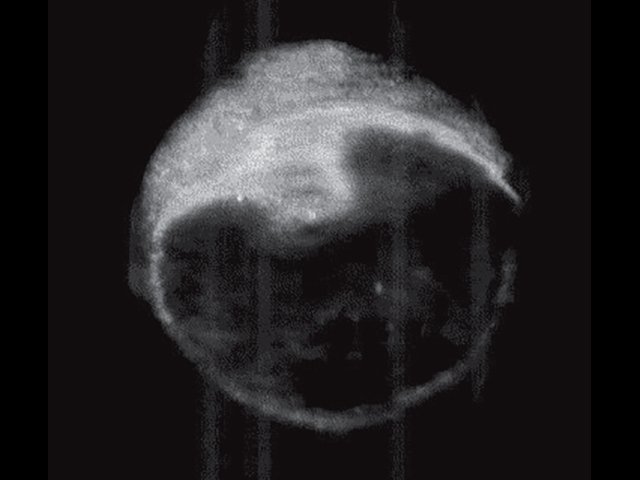 УЗ-картина левой молочной железы с эндопротезом - передняя проекция, коронарный срез на глубине 14 мм