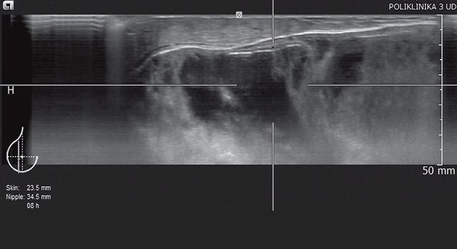 УЗ-картина правой молочной железы с эндопротезом - передняя проекция, сагиттальный срез