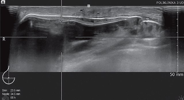 УЗ-картина левой молочной железы с эндопротезом - передняя проекция, горизонтальный срез