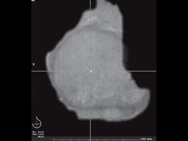 УЗ-картина левой молочной железы после мастэктомии - передняя проекция, коронарный срез на глубине 0 мм