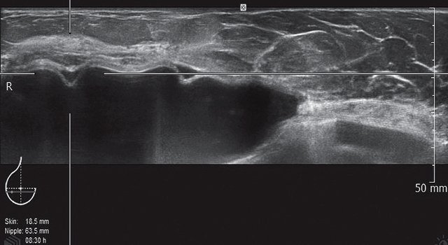 УЗ-картина правой молочной железы после мастэктомии - передняя проекция, горизонтальный срез