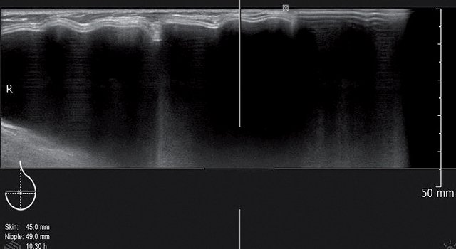 УЗ-картина левой молочной железы после мастэктомии - передняя проекция, горизонтальный срез