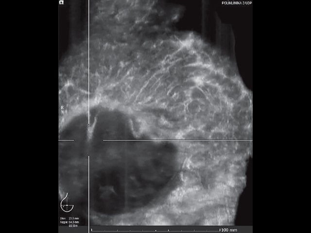 УЗ-картина правой молочной железы после мастэктомии - передняя проекция, коронарный срез на глубине 23.5 мм