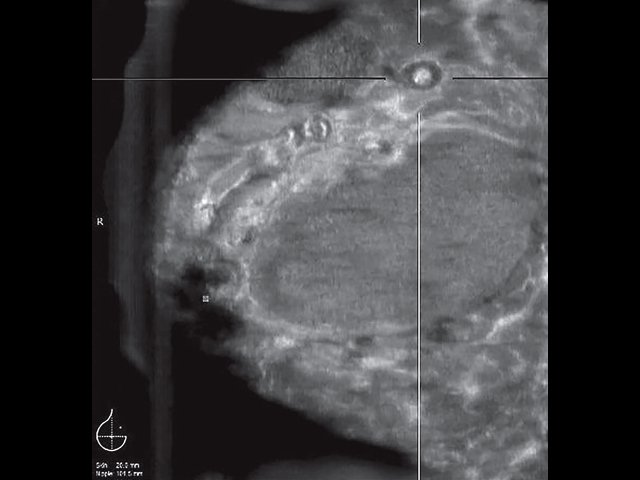 УЗ-картина правой молочной железы - полиакриламидный маммарный синдром