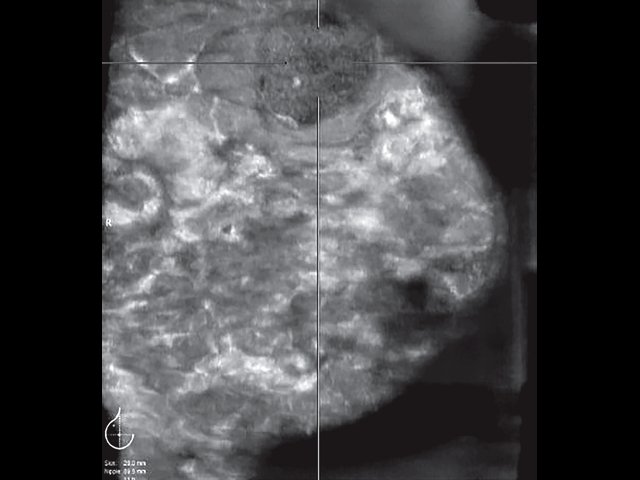 УЗ-картина левой молочной железы - полиакриламидный маммарный синдром
