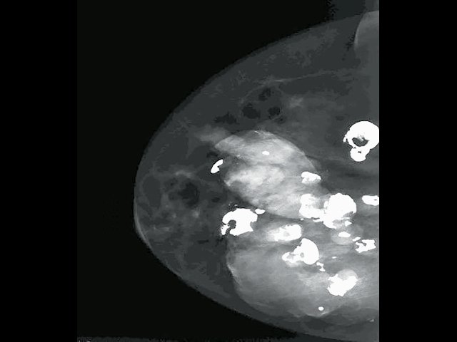 Томосинтез правой молочной железы - полиакриламидный маммарный синдром