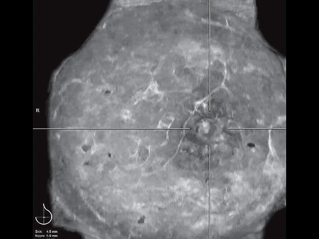 УЗ-картина молочной железы через 2,5 года после липотрансфера - объемное сканирование, коронарный срез